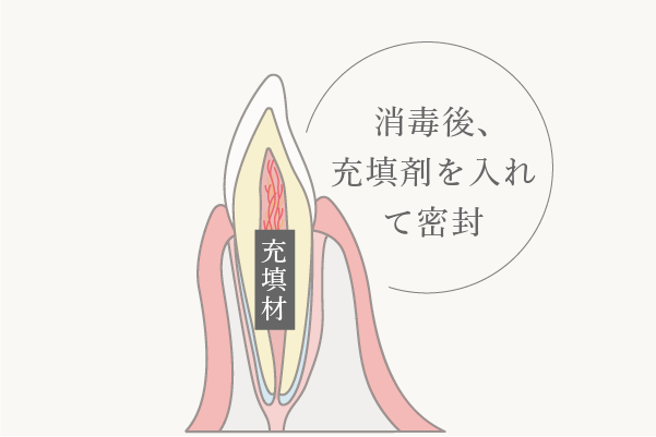 根管治療のイメージ
