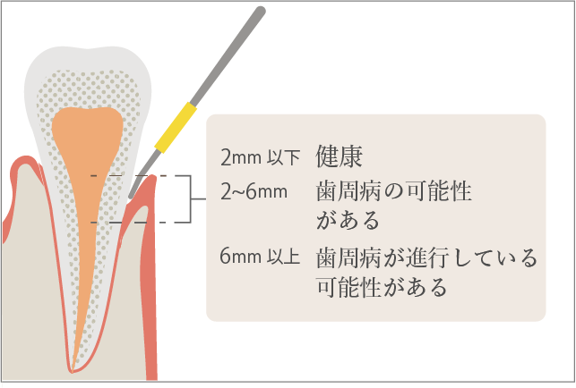 歯周病ポケットの模式図