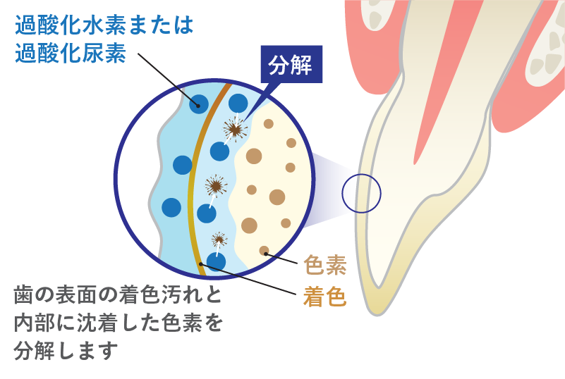 歯周病ポケットの模式図